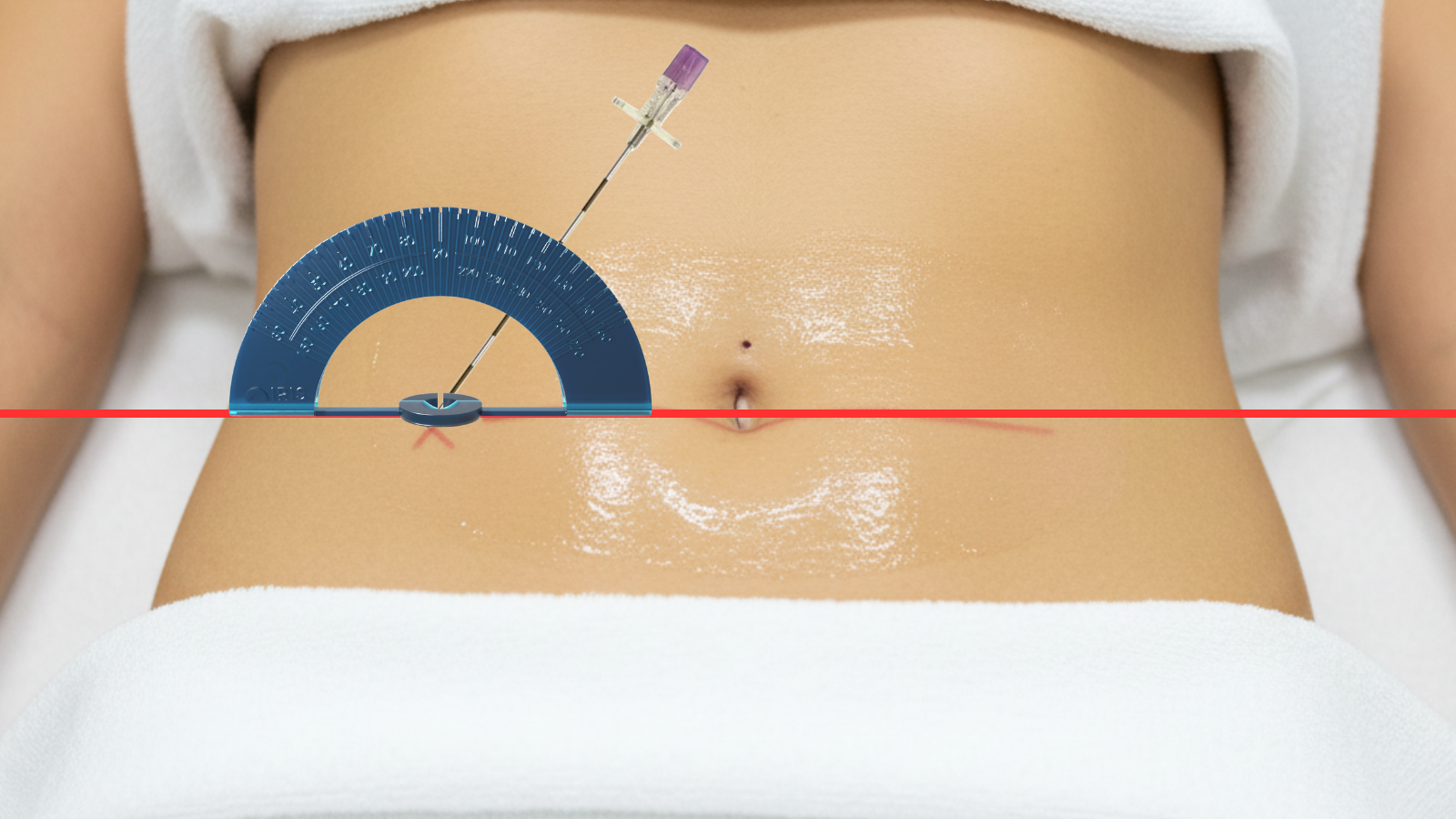 Step 3: Position needle